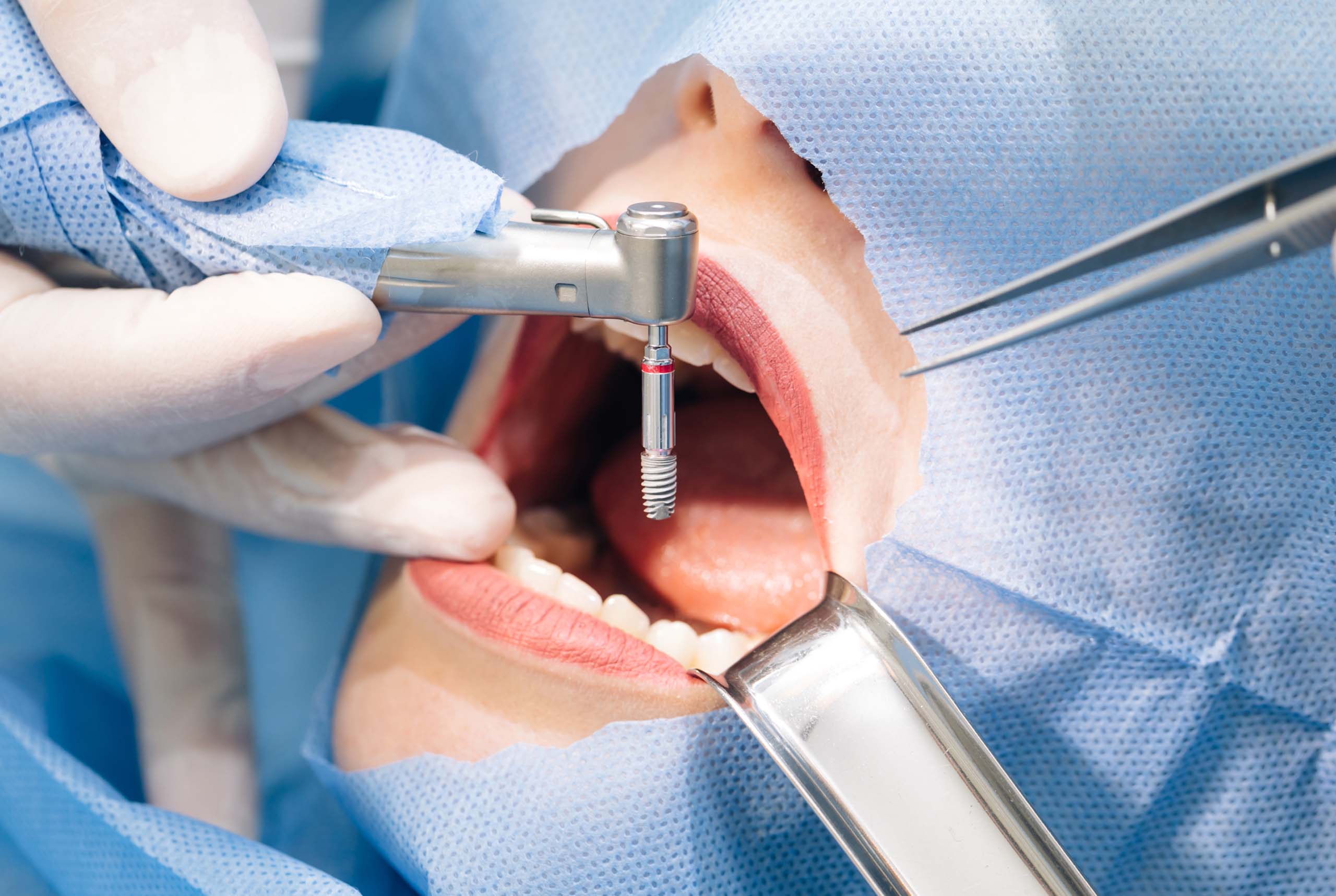 inštaláca zubného implantátu 
